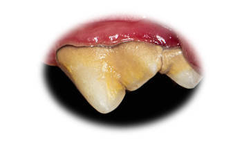 early periodontal disease on canine tooth