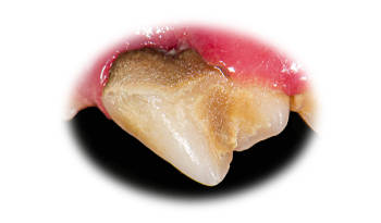 moderate periodontal disease on canine tooth